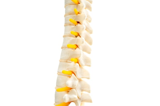 Lumbar spine displaced herniated disc fragment, spinal nerve and bone. Model for treatment medical in the orthopedic department. photo