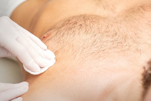 Young caucasian man receiving hair removal from his chest in a beauty salon, depilation men's torso. photo