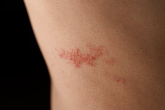 Man with shingles disease, skin infected with Herpes zoster, virus, Healthcare and medical. photo