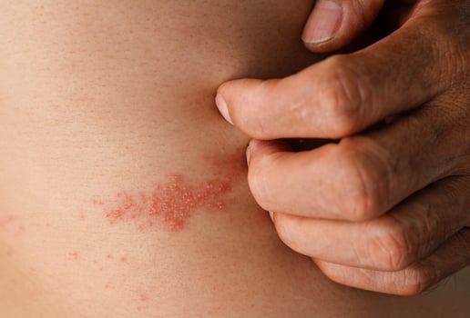 Man with shingles disease, skin infected with Herpes zoster, virus, Healthcare and medical. photo