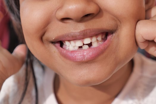 detail shot of child with teeth missing photo