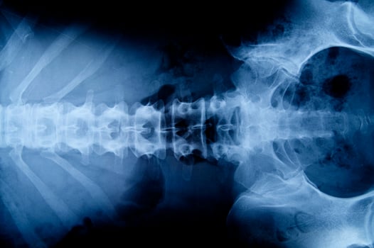 a x - ray image of a person's back photo