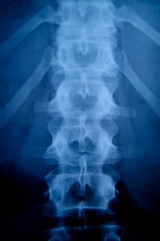 a x - ray image of a person's back photo