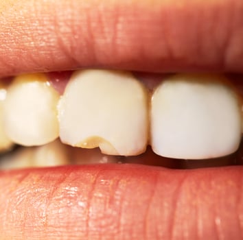 Macro shot of the broken tooth. photo