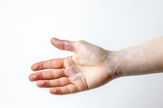 Skin diseases-allergies, psoriasis, eczema, dermatitis, Symptoms of health issues and disease,Generative AI illustration photo