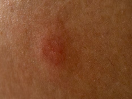 Purulent inflammation, ulcers, chronic itching photo