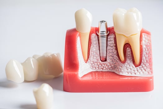 Dental implant, artificial tooth roots into jaw, root canal of dental treatment, gum disease, teeth model for dentist studying about dentistry. photo