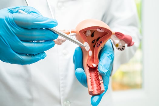 Uterus, doctor holding anatomy model for study diagnosis and treatment in hospital. photo