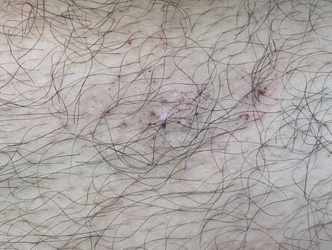 close up wound on skin photo
