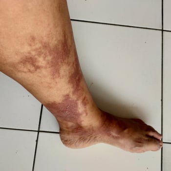 Horrible burns on left leg. Burns due to being scalded by hot water. Blistered skin. Reddish skin photo