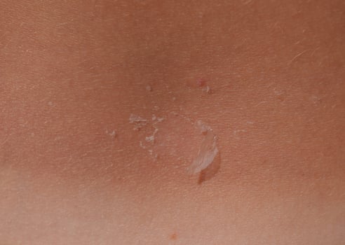 Sunburn on the skin of the back. Exfoliation, skin peels off. Dangerous sun tan photo