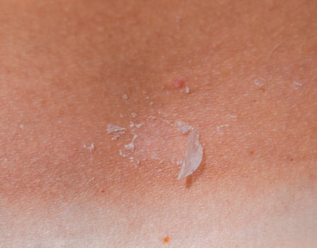 Sunburn on the skin of the back. Exfoliation, skin peels off. Dangerous sun tan photo