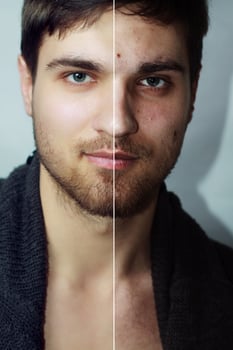 Before and after cosmetic operation. Young pretty man portrait photo
