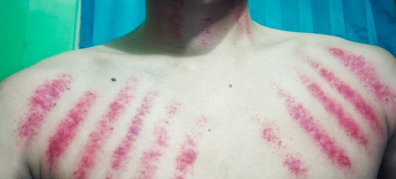 Red marks from coin scratches on a man's chest. Kerokan is a traditional Javanese treatment method for treating the symptoms of colds. This treatment method is quite popular in Indonesia photo