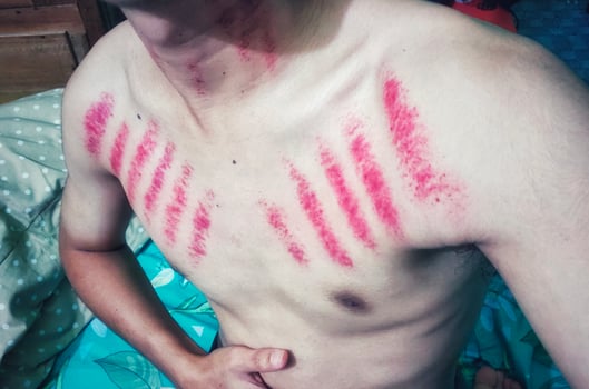 Red marks from coin scratches on a man's chest. Kerokan is a traditional Javanese treatment method for treating the symptoms of colds. This treatment method is quite popular in Indonesia photo