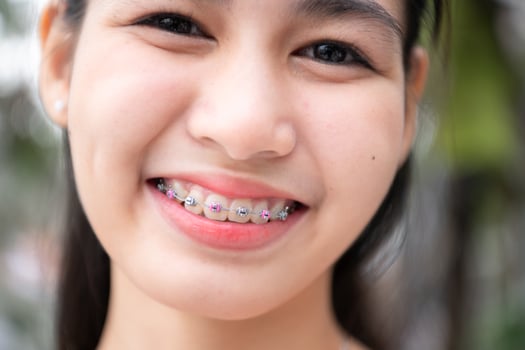 Portrait of a young asian woman with braces on her teeth photo