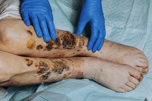 On the legs of an elderly woman, the skin peels off due to eczema, swelling of the legs. Yellowing of the nail plate. Swelling of the legs. Consequences of diabetes in the elderly. Elderly care photo