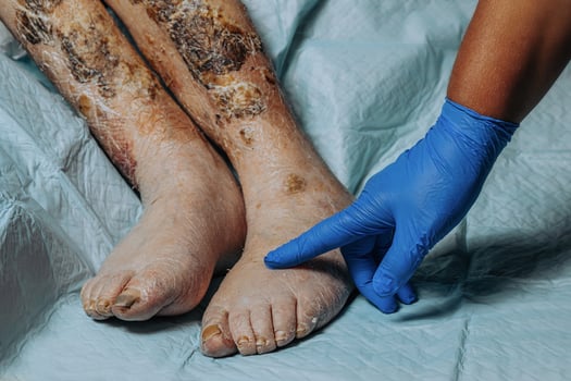 On the legs of an elderly woman, the skin peels off due to eczema, swelling of the legs. Yellowing of the nail plate. Swelling of the legs. Consequences of diabetes in the elderly. Elderly care photo