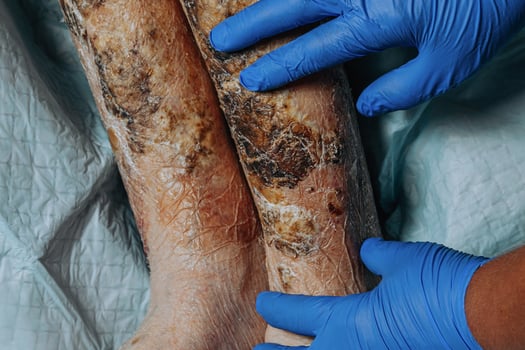 On the legs of an elderly woman, the skin peels off due to eczema, swelling of the legs. Yellowing of the nail plate. Swelling of the legs. Consequences of diabetes in the elderly. Elderly care photo