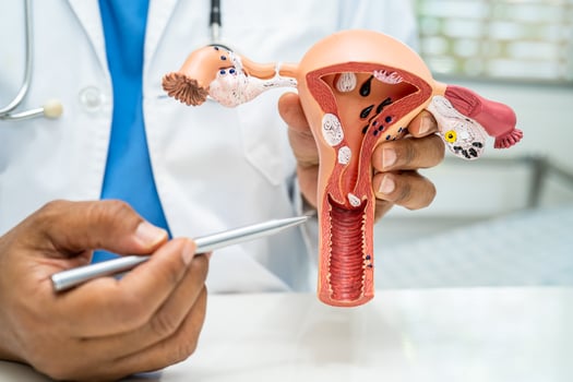 Uterus, doctor with anatomy model for study diagnosis and treatment in hospital. photo