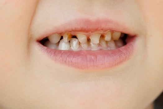 Children's milk teeth with caries. Close-up of unhealthy milk teeth. Dental medicine and healthcare - patient's open mouth showing caries. Children's dentist. photo