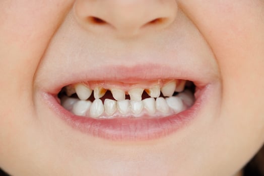 Children's milk teeth with caries. Close-up of unhealthy milk teeth. Dental medicine and healthcare - patient's open mouth showing caries. Children's dentist. photo