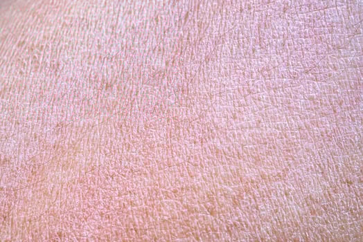 dry and dehydrated human skin texture background photo