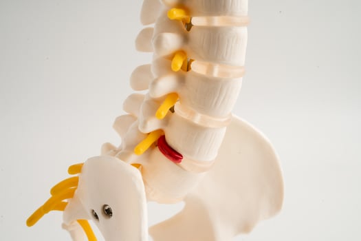 Lumbar spine displaced herniated disc fragment, spinal nerve and bone. Model for treatment medical in the orthopedic department. photo