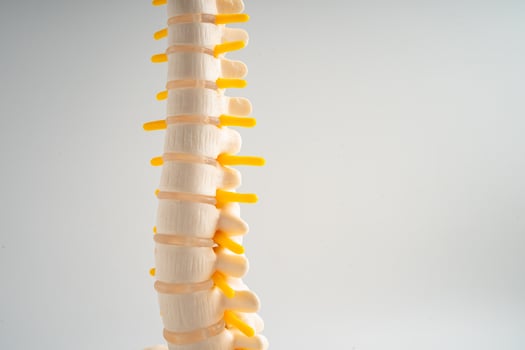Lumbar spine displaced herniated disc fragment, spinal nerve and bone. Model for treatment medical in the orthopedic department. photo