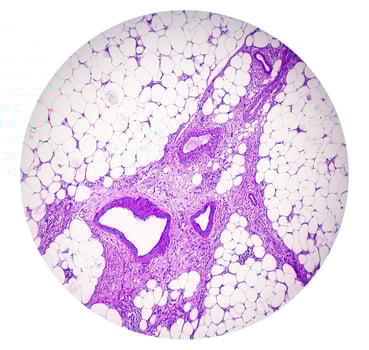 Photomicrography, Skin tissue biopsy showing Lichen planus. T-cell mediated autoimmune disorder. photo