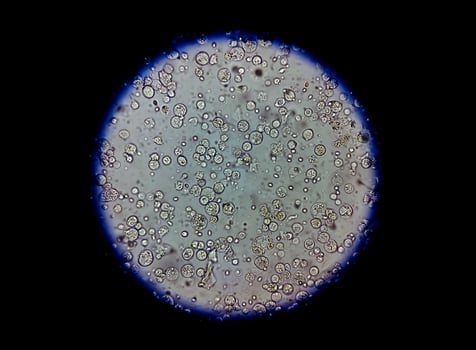 Photomicrograph of urinalysis showing plenty pus cells, urinary tract infection. photo