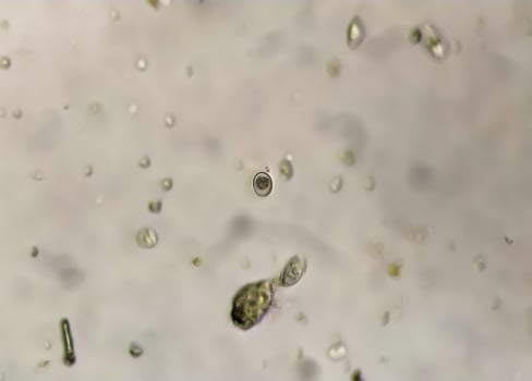 Schistosoma Parasite ova in human urine specimen under microscope. Urinary parasite photo
