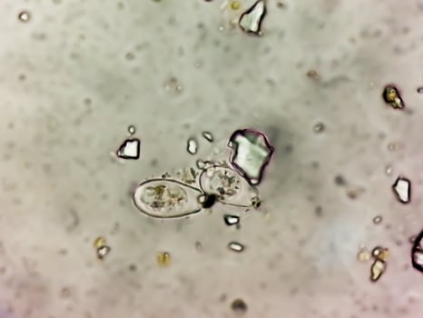 Schistosoma Parasite ova in human urine specimen under microscope. Urinary parasite photo