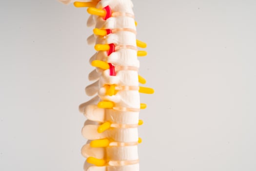 Lumbar spine displaced herniated disc fragment, spinal nerve and bone. Model for treatment medical in the orthopedic department. photo