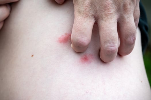 Bites on the skin of a man. photo