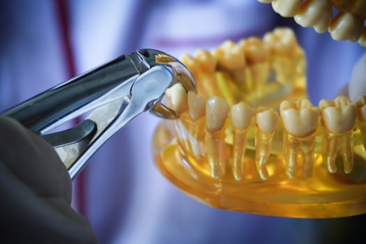 Dentist with a layout of the human jaw is showing how to extract a sick tooth with dental pliers. photo