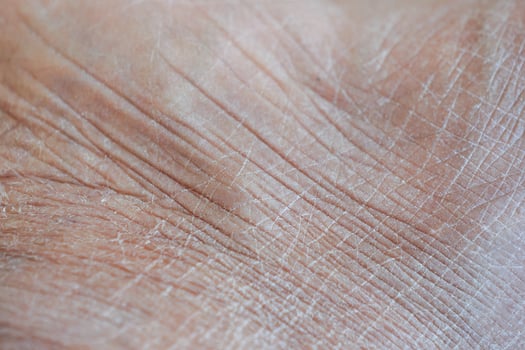 Closeup view of dry human skin . photo