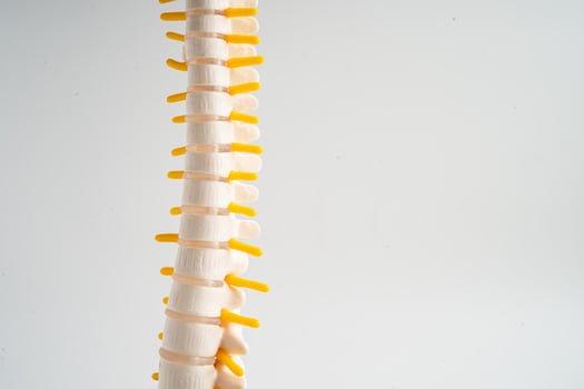 Lumbar spine displaced herniated disc fragment, spinal nerve and bone. Model for treatment medical in the orthopedic department. photo