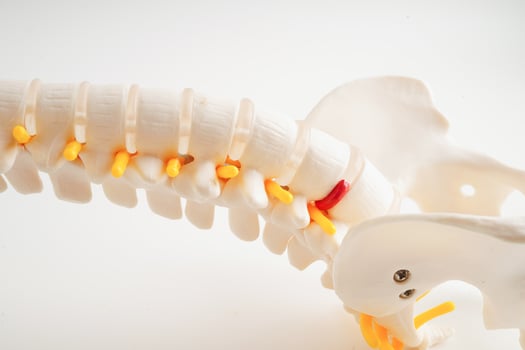 Spinal nerve and bone, Lumbar spine displaced herniated disc fragment, Model for treatment medical in the orthopedic department. photo
