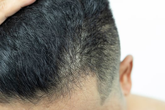 Close Up Young people have problems with hair loss, dryness, dullness, split ends and damage. photo