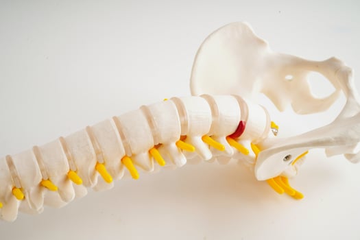 Spinal nerve and bone, Lumbar spine displaced herniated disc fragment, Model for treatment medical in the orthopedic department. photo