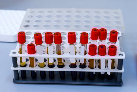 Rack of blood tubes test for analysis in the laboratory of hematology. Pneumonia diagnosing. COVID-19 and coronavirus identification. Pandemic. photo