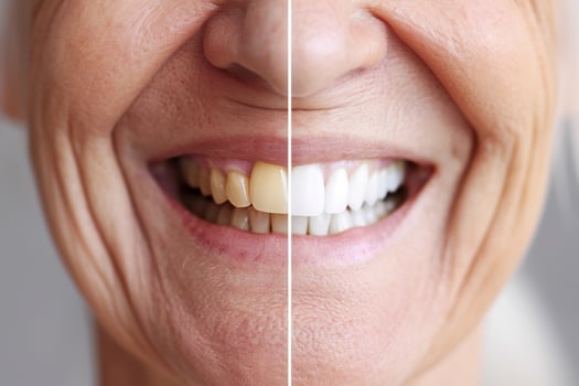 Comparison of a senior woman smile before and after teeth whitening photo