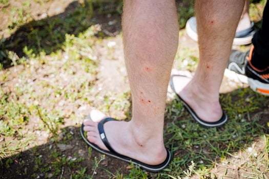 The tourist stands in flip-flops, human legs bitten by a midge, traces of mosquito bites, sore legs, foci of skin irritation. photo
