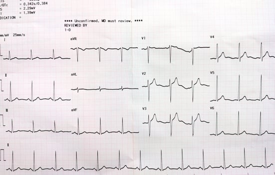 Graph showing the results of the electrocardiogram test on recording paper. photo