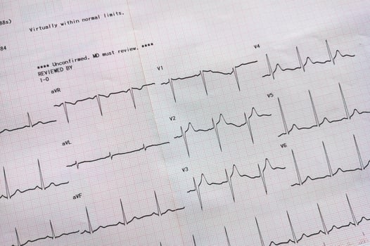 Graph showing the results of the electrocardiogram test on recording paper. photo