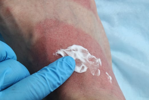 A doctor in blue gloves makes cream treatment on redness woman's leg as result of skin burn. Foot soreness after sunburn. Dermatology problems. Inflammation sensitive skin from allergies. Thermal burn photo