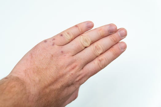 Painful rash, red blisters on a man's arm. Human hands with dermatitis, allergy rash. Enterovirus. Coxsackie virus. Allergic rash on the hands of an adult man photo