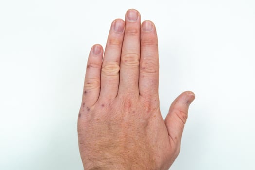 Painful rash, red blisters on a man's arm. Human hands with dermatitis, allergy rash. Enterovirus. Coxsackie virus. Allergic rash on the hands of an adult man photo