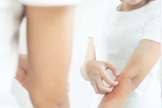 skin problem and beauty. Young woman scratch body has itchy skin from skin allergic, steroid allergy, sensitive skin, red from sunburn, chemical allergy, rash, insect bites, Seborrheic Dermatitis. photo